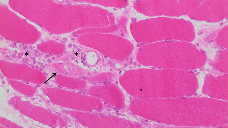 Immanuel Krankenhaus Berlin - Rheumatologie - Mikroskopisches Bild (sog. HE-Färbung) einer Muskelprobe mit Darstellung vieler Entzündungszellen (Sterne) und geschädigten Muskelzellen (Pfeil) als Zeichen der Muskelentzündung Immanuel Krankenhaus Berlin - Rheumatologie - Mikroskopisches Bild (sog. HE-Färbung) einer Muskelprobe mit Darstellung vieler Entzündungszellen (Sterne) und geschädigten Muskelzellen (Pfeil) als Zeichen der Muskelentzündung